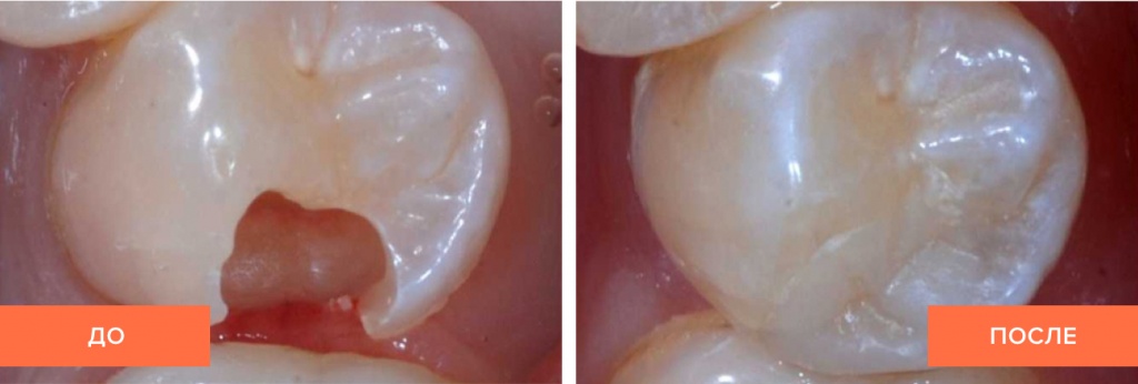 До и после установки зубной вкладки