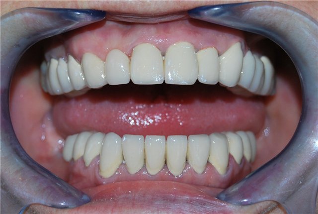 Зубы пластмассовые фронтальные