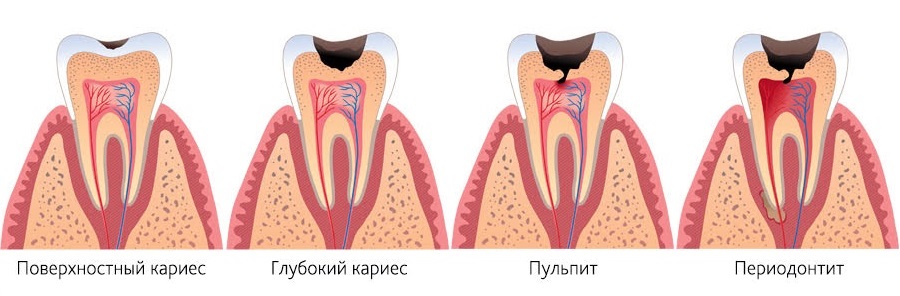 Распространенное лечение зубов у детей
