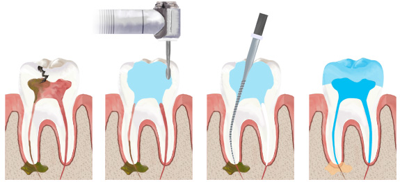 Удаление зубного нерва этапы