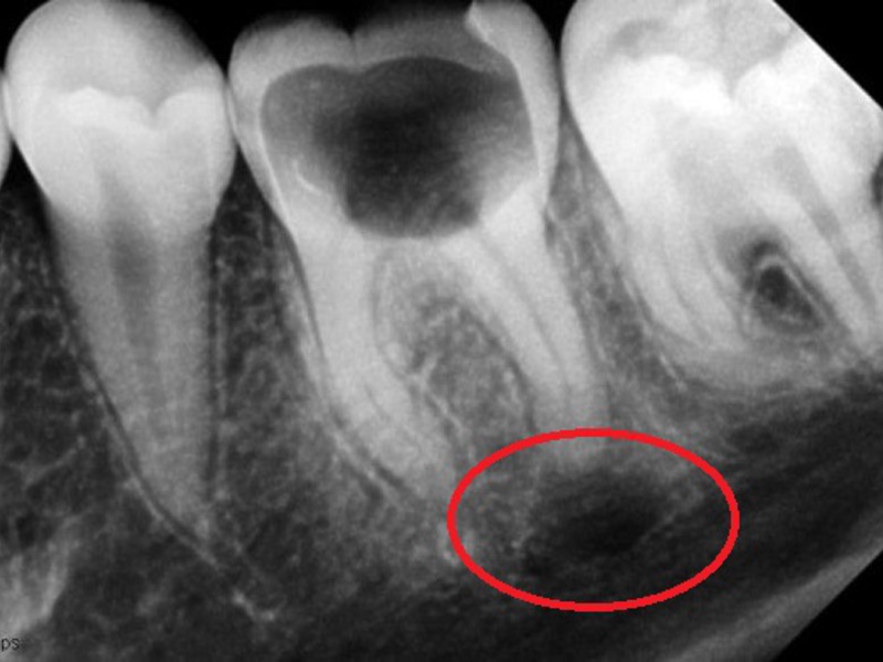Лечение кисты зуба рентген