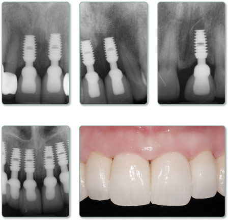 Зубные импланты Bicon фото