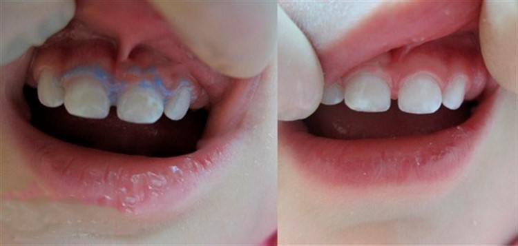 до и после серебрение молочных зубов