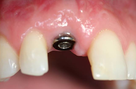 Зубные импланты Ankylos в действии