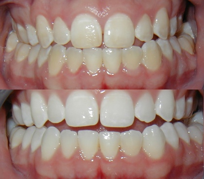 Отбеливание зубов Opalescence Boost до и после