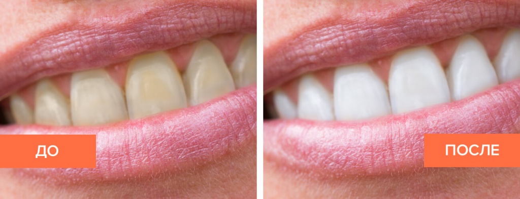 Фотоотбеливание зубов до и после