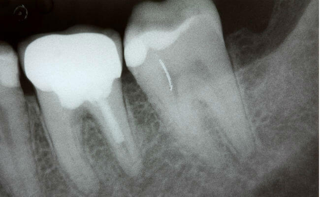 Как выглядит снимок зубов: фото рентгена