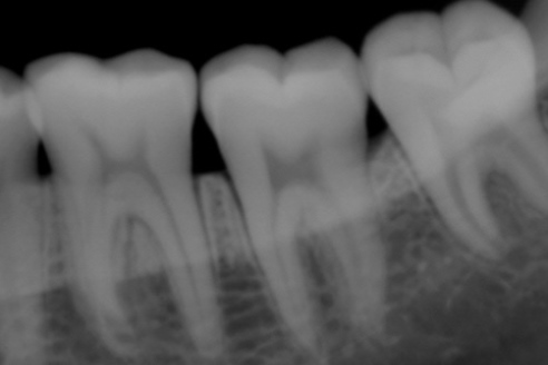 Прицельный снимок зубов
