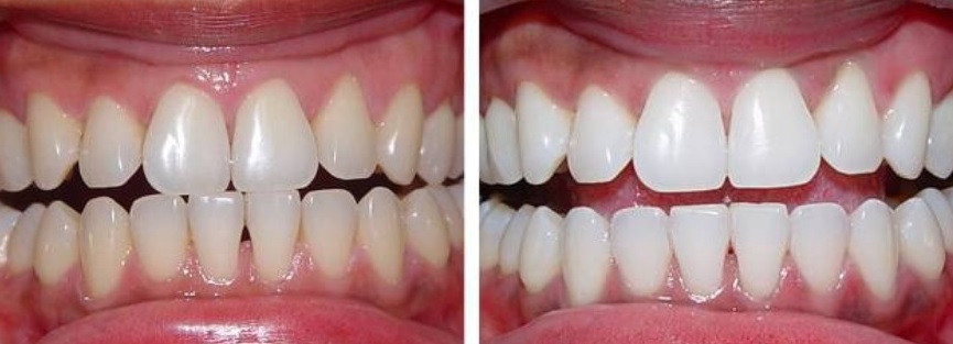 Лазерное отбеливание зубов, до и после