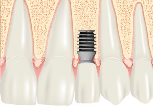 Зубные импланты Bicon