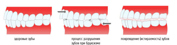 Влияние бруксизма на зубы